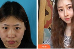 成都市錦江區(qū)第二人民醫(yī)院醫(yī)學(xué)美容科王嘉勛整形價格表附鼻整形案例展示