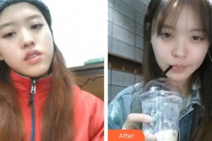 成都俏百顏美容整形醫(yī)院張強整形價格表附自體脂肪全臉填充案例展示