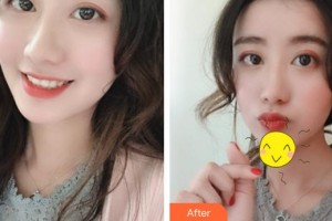 成都元辰醫(yī)學(xué)美容門診部巫國輝 整形價格表附面部填充案例展示