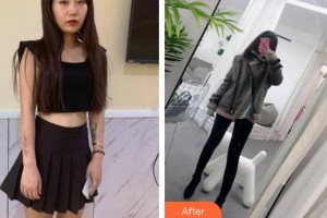 成都青羊區(qū)第五人民醫(yī)院疤痕科陳玉龍整形價格表附手術(shù)疤痕案例展示