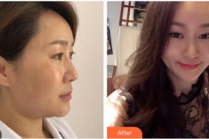 成都嬌點醫(yī)學(xué)美容醫(yī)院韓飛整形價格表附EDS中下面部提升案例展示