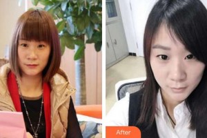 成都嬌點醫(yī)學(xué)美容醫(yī)院張麗梅整形價格表附祛斑案例展示