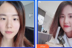 成都市錦江區(qū)第二人民醫(yī)院醫(yī)學(xué)美容科安娜整形價格表附眼部手術(shù)案例展示