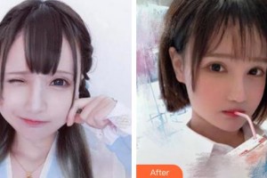 成都雍禾植發(fā)醫(yī)院李丙雙整形價格表附種植發(fā)際線案例展示