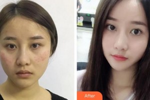 成都艾米麗醫(yī)療美容門診部秦小梅整形價格表附超激光美膚祛斑案例展示