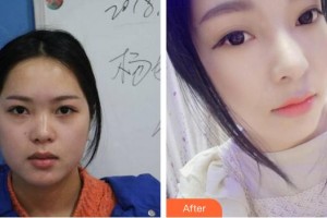 成都華顏醫(yī)療美容門診部胡宇昆整形價格表附鼻部手術(shù)案例展示