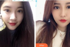 成都百齡駐顏醫(yī)學(xué)美容門診部劉祎整形價格表附雙眼皮 眼部手術(shù)案例展示