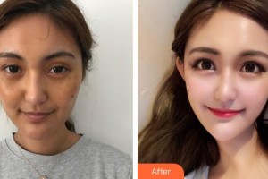 成都菲格醫(yī)療美容門診部陳謝娟整形價格表附超激光美膚祛斑案例展示