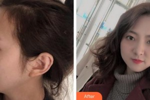 成都市錦江區(qū)第二人民醫(yī)院醫(yī)學(xué)美容科王鳳整形價格表附雙眼皮案例展示