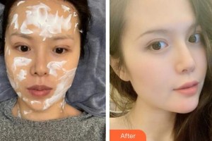 成都春天醫(yī)療美容門診部許麗君整形價格表附熱瑪吉案例展示