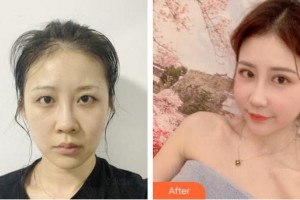 成都市錦江區(qū)第二人民醫(yī)院醫(yī)學(xué)美容科曾一茜整形價格表附切開雙眼皮案例展示