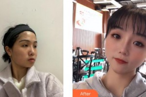 成都美立方（原華博）醫(yī)療美容醫(yī)院楊黎黎整形價格表附面部案例展示