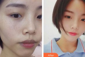 成都晶膚醫(yī)學(xué)美容醫(yī)院趙一謙整形價(jià)格表附祛雀斑案例展示