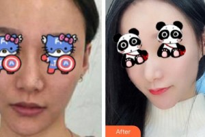 成都晶膚醫(yī)學(xué)美容醫(yī)院陳佳整形價(jià)格表附光子嫩膚案例展示