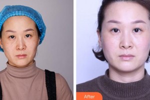 成都唯羅納醫(yī)療美容門診部李士武整形價(jià)格表附超激光美膚祛斑案例展示