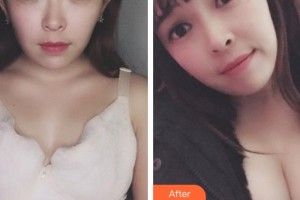 成都景華醫(yī)學(xué)美容門診部趙景華整形價(jià)格表附濃縮豐胸真實(shí)案例展示