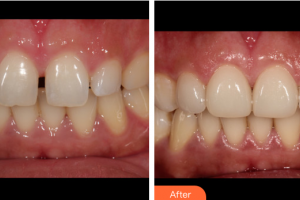 廣州海峽醫(yī)學(xué)整形美容醫(yī)院周顯峰整形價(jià)格表附牙齒貼面案例展示