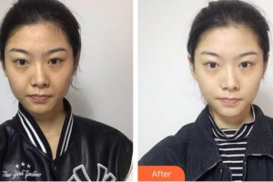 成都瑞美薈醫(yī)療美容醫(yī)院黃薪整形價格表附埋線提升案例展示