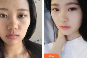 成都瑞美薈醫(yī)療美容醫(yī)院董理整形價格表附鼻部手術(shù)案例展示