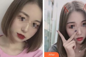 成都赫拉醫(yī)療美容整形醫(yī)院曾俊君整形價格表附下頜緣瘦臉術(shù)案例展示