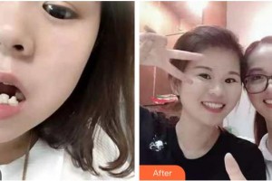 成都拜博拜爾口腔醫(yī)院詹瀚整形價格表附牙齒矯正案例展示