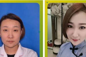 成都年輕化社醫(yī)療美容診所張曉鳳老師整形價(jià)格表附眼部綜合案例展示