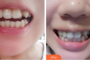 成都唐牙科門診部周麗容整形價(jià)格表附牙齒矯正案例展示