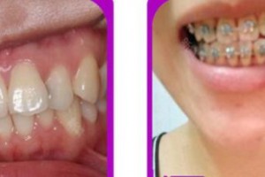 成都華美牙科悅齒門診部鐘果成整形價(jià)格表附牙齒矯正案例展示