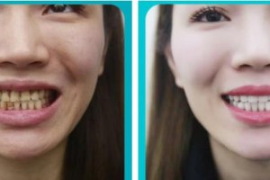 成都華美牙科悅齒門診部田洪君整形價(jià)格表附牙齒美白案例展示