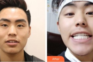 成都瑞泰融誠口腔醫(yī)院劉澤萍整形價(jià)格表附牙齒縫隙矯正案例展示