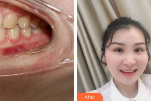 成都瑞泰融誠口腔醫(yī)院孫勁東整形價(jià)格表附半隱形牙齒矯正案例展示