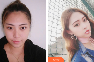 廣州海峽醫(yī)學(xué)整形美容醫(yī)院李冠穎整形價(jià)格表附鼻部手術(shù)案例展示