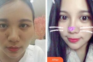 成都臻愛唯美醫(yī)療美容醫(yī)院葉飛輪整形價(jià)格表附美眼翹鼻套餐案例展示