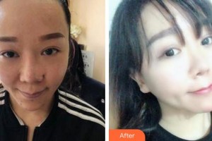 成都首瑞毛發(fā)移植醫(yī)療美容診所汪軍院長整形價(jià)格表附植發(fā)案例展示