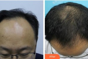 成都博愛醫(yī)院（胎記美容中心）余紅彬整形價(jià)格表附植發(fā)案例展示