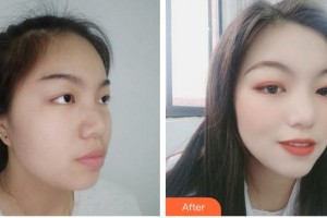 成都科思研醫(yī)療美容診所趙澤方整形價(jià)格表附補(bǔ)水保濕案例展示