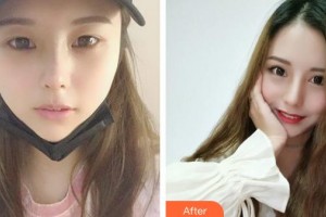 成都格萊麗醫(yī)療美容門診部石峰整形價(jià)格表附切開雙眼皮案例展示