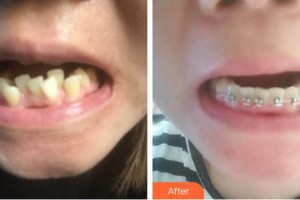 成都金琴口腔門診部王輝整形價(jià)格表附金屬托槽矯正案例展示