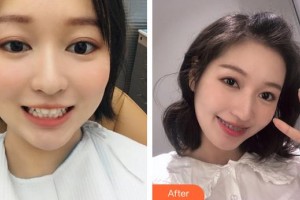 成都拉斐爾口腔門診部王雪梅整形價(jià)格表附牙齒矯正案例展示