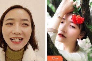 成都科瓦齒科門診部徐瑛整形價(jià)格表附金屬托槽矯正案例展示