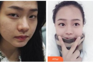 成都忠愛醫(yī)療美容診所王瑩瑩整形價(jià)格表附眼部綜合案例展示