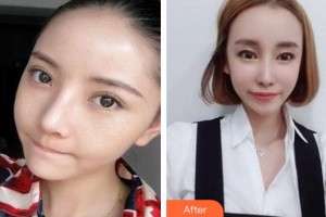 成都潤禾皮膚病?？漆t(yī)院殷明坤整形價格表附祛斑案例展示