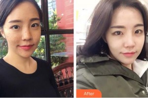 成都潤禾皮膚病?？漆t(yī)院李艷整形價格表附祛痘美膚案例展示