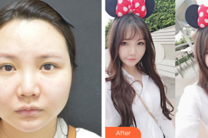 廣州軍區(qū)武漢總醫(yī)院醫(yī)學(xué)整形美容中心郭亮整形價(jià)格表附面部輪廓案例展示