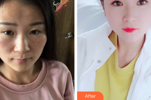 廣州軍區(qū)武漢總醫(yī)院醫(yī)學(xué)整形美容中心孔生生整形價(jià)格表附激光祛斑案例展示