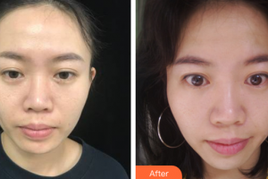 廣州軍區(qū)武漢總醫(yī)院醫(yī)學(xué)整形美容中心彭靜整形價(jià)格表附二氧化碳點(diǎn)陣激光案例展示