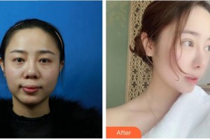 成都安莎貝拉醫(yī)療美容門診部文惠英整形價格表附鼻部綜合案例展示