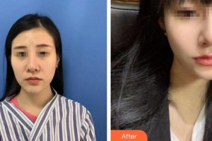 成都晶都醫(yī)療美容醫(yī)院林鴻祥整形價格表附多方面部埋線提升案例展示