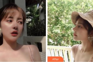 成都晶都醫(yī)療美容醫(yī)院王芳整形價格表附活氧煥膚案例展示