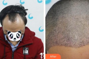 成都絲緣毛發(fā)醫(yī)療美容門診部陳戰(zhàn)兵整形價格表附植發(fā)案例展示